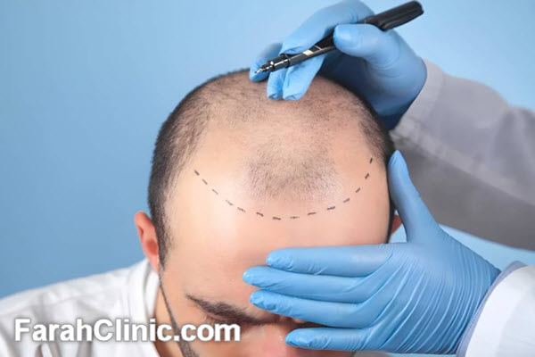 انجام کاشت موی طبیعی در کلینیک تخصصی کاشت مو در غرب تهران | فرح کلینیک