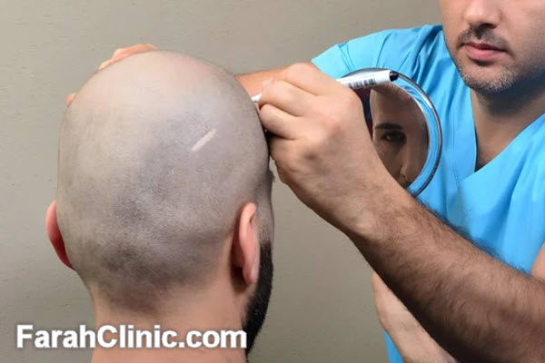 ویژگی های کلینیک تخصصی کاشت مو در غرب تهران | فرح کلینیک