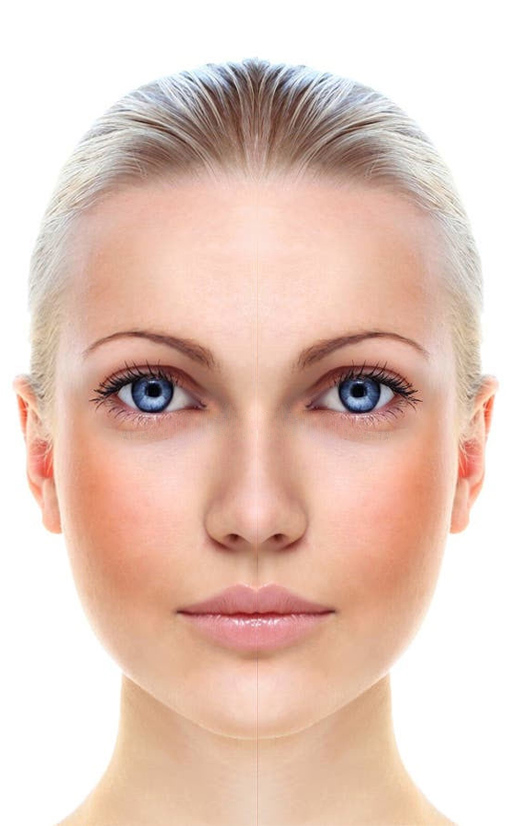 تصویر بعد جوانسازی پوست | فرح کلینیک