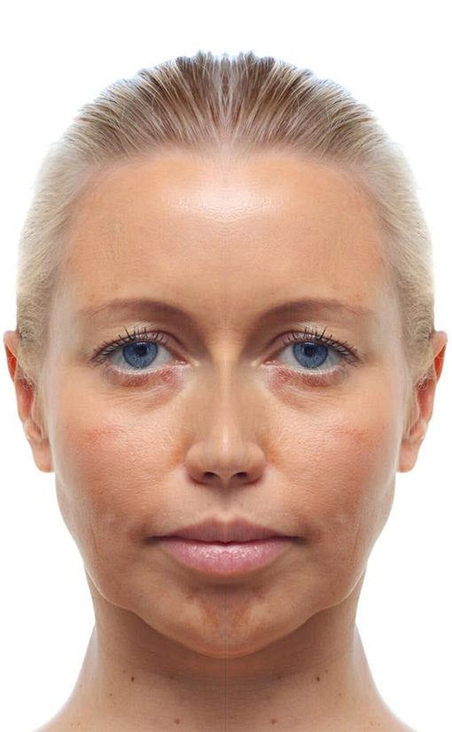 تصویر قبل جوانسازی پوست | فرح کلینیک