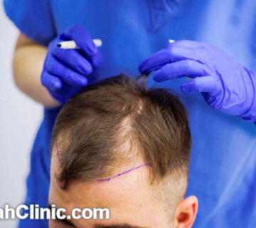 کلینیک تخصصی کاشت مو در غرب تهران | فرح کلینیک