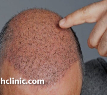 دوره تخصصی پیوند مو