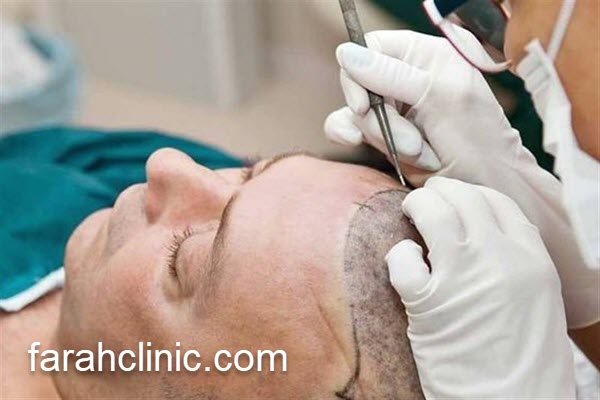 پزشک متخصص آموزش کاشت مو | فرح کلینیک 