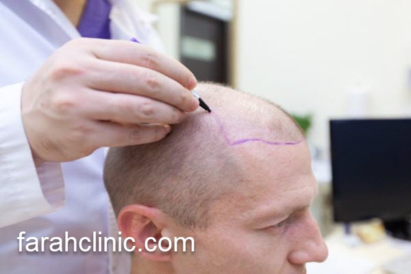 بهترین دکتر آموزش کاشت مو | فرح کلینیک