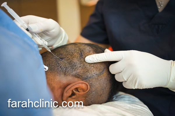 آشنایی با بهترین کلینیک کاشت مو | فرح کلینیک 