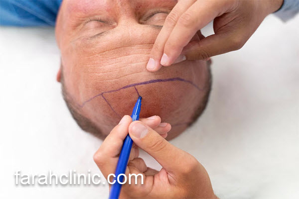 مرکز تخصصی آموزش کاشت مو در غرب تهران | فرح کلینیک 