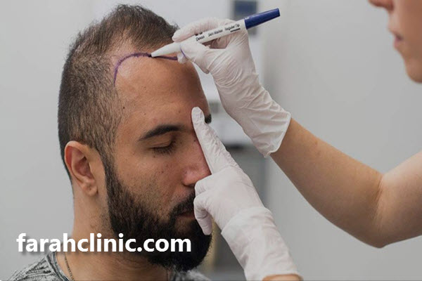 چه کسانی می توانند مدرک کاشت مو بگیرند؟