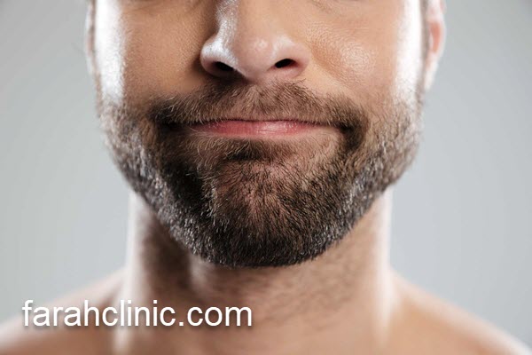 کاشت ریش و سبیل طبیعی | فرح کلینیک