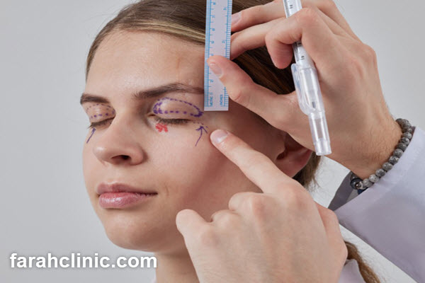 بلفاروپلاستی | فرح کلینیک
