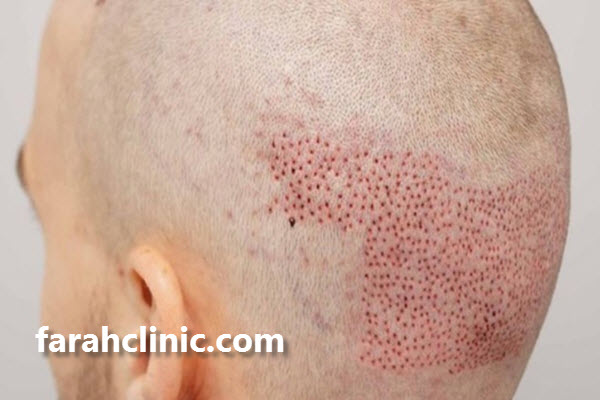 آموزش کاشت مو در غرب تهران