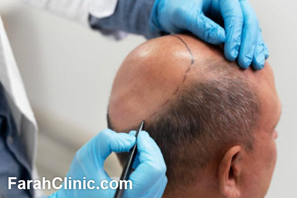 دوره آموزش کاشت مو در تهران | فرح کلینیک