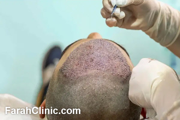 انتخاب بهترین مرکز آموزش کاشت مو در غرب تهران | فرح کلینیک