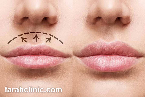 بهترین کلینیک سانترال لب | فرح کلینیک