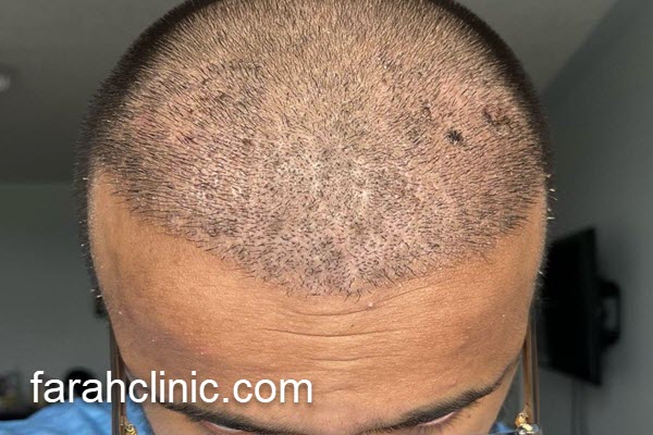 آشنایی با بهترین کلینیک کاشت مو | فرح کلینیک 