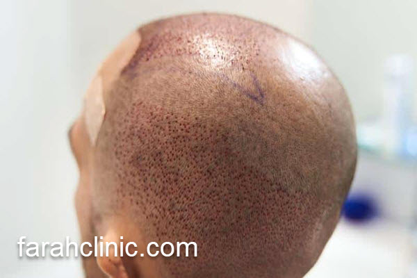 بهترین مرکز کاشت مو در غرب تهران | فرح کلینیک