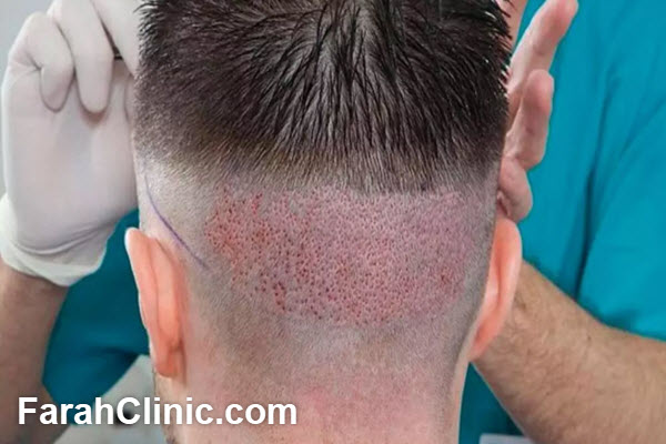 برگزاری دوره های آموزشی کاشت مو در غرب تهران | فرح کلینیک