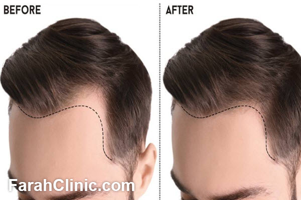 بهترین دکتر کاشت مو در تهران | فرح کلینیک