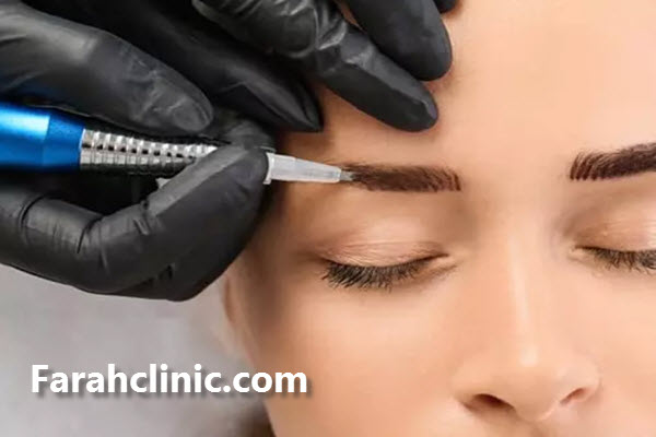 کاشت ابرو چیست؟ | غرب تهران