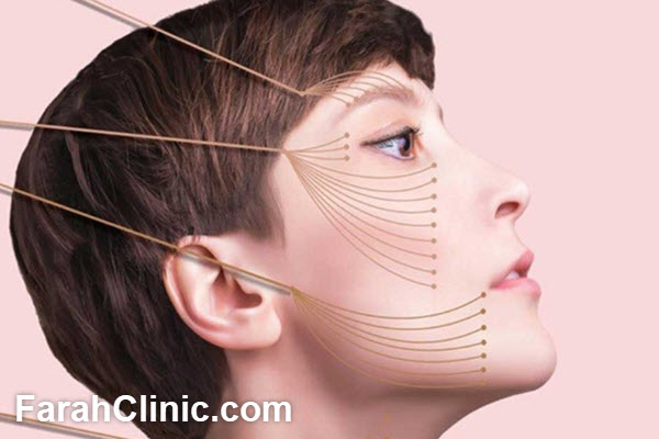 لیفت صورت با نخ چگونه انجام می شود؟ | فرح کلینیک