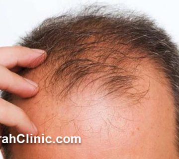 بهترین کلینیک کاشت مو در میرداماد