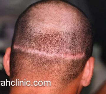 کاشت مو با بهترین روش | فرح کلینیک