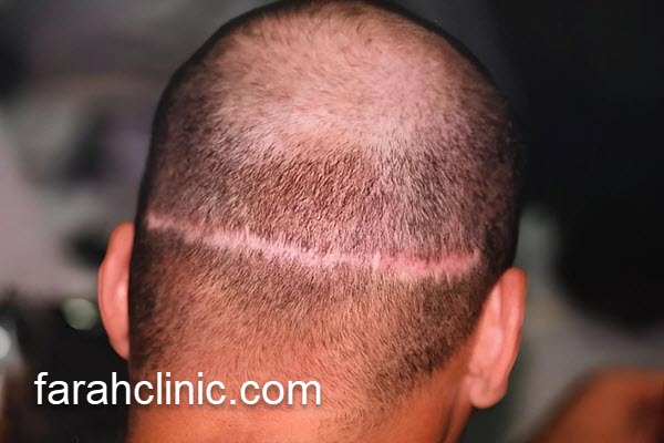 کاشت مو با بهترین روش | فرح کلینیک