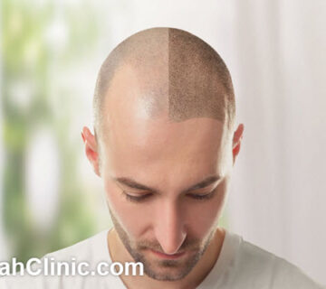 هزینه دوره کاشت مو چقدر است؟ | فرح کلینیک