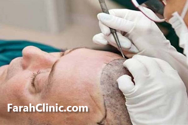 دوره آموزش تخصصی کاشت مو در غرب تهران