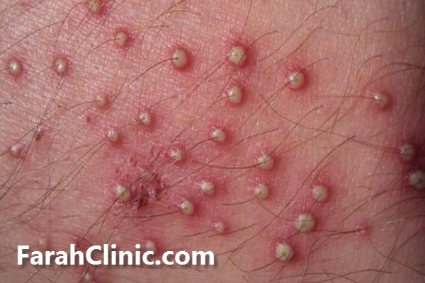 روش های تشخیص زگیل تناسلی