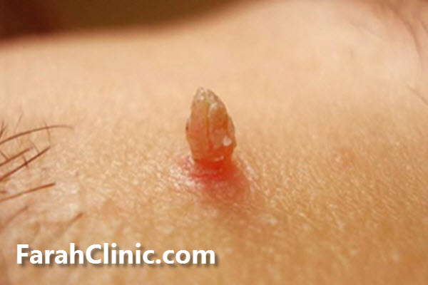 روش های درمان زگیل تناسلی