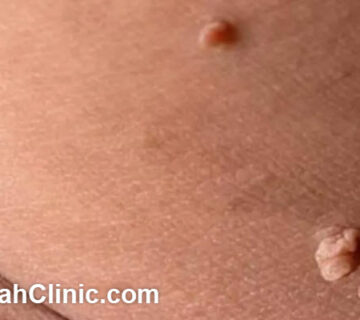 دکتر متخصص زگیل تناسلی در غرب تهران