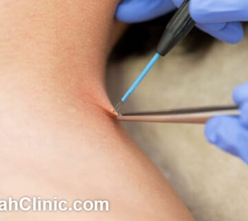 مرکز درمان زگیل تناسلی در غرب تهران