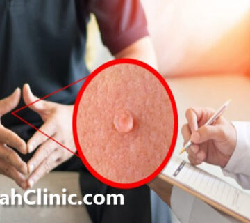 بهترین کلینیک درمان زگیل تناسلی در تهران