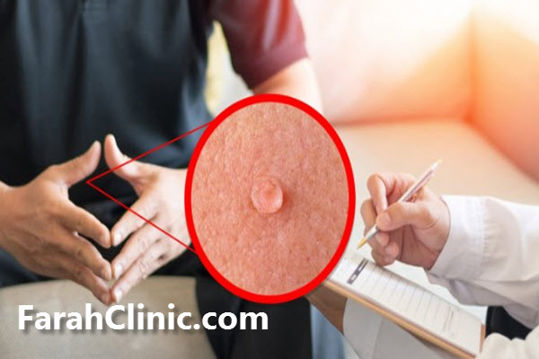 بهترین کلینیک درمان زگیل تناسلی در تهران