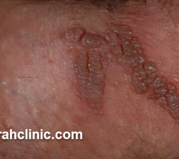 هزینه درمان اچ پی وی HPV در سال 1404