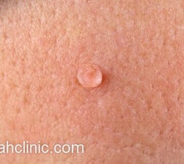 درمان زگیل تناسلی در کلینیک معتبر | فرح کلینیک