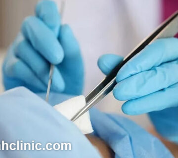 هزینه لیزر زگیل تناسلی در تهران چقدر است؟