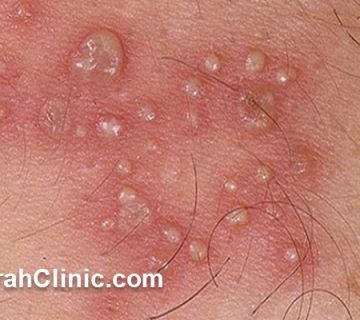 دکتر متخصص زگیل تناسلی در میرداماد