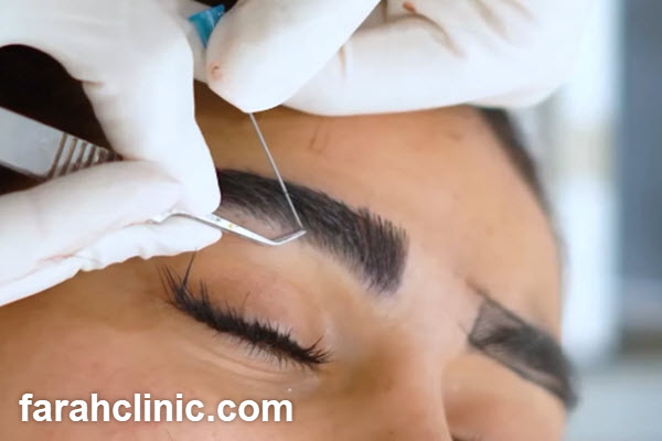 ویژگی های بهترین مرکز کاشت ابرو در سعادت آباد