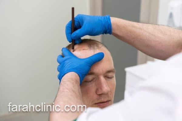 بهترین روش برای انجام کاشت مو | فرح کلینیک