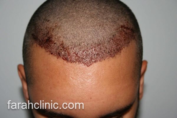 تکنیک جدید کاشت مو | فرح کلینیک