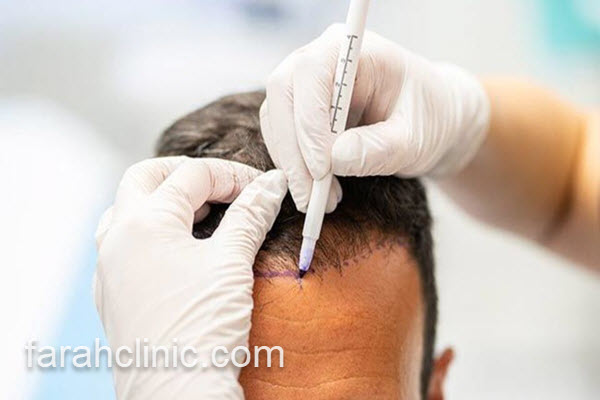 بهترین روش برای کاشت مو بدون درد | فرح کلینیک