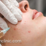 رفع جای جوش و اسکار با سابسیژن | فرح کلینیک