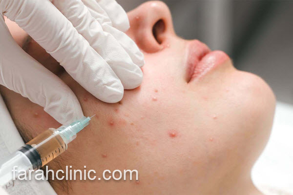 رفع جای جوش و اسکار با سابسیژن | فرح کلینیک