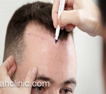 کاشت مو با سریع ترین روش | فرح کلینیک