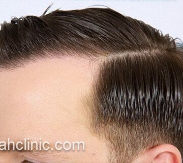 کاشت مو با روش جدید در سعادت آباد | فرح کلینیک