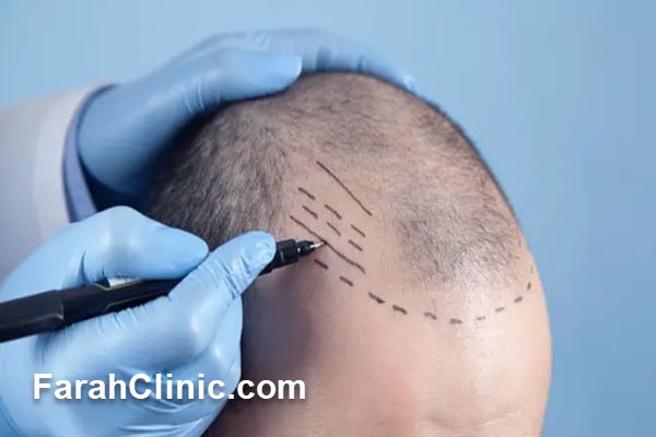 مراقبت‌ های بعد از کاشت مو