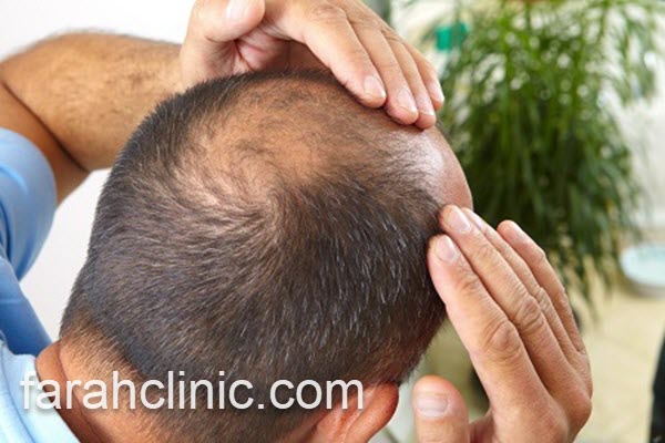 جدیدترین روش کاشت مو در غرب تهران | فرح کلینیک 