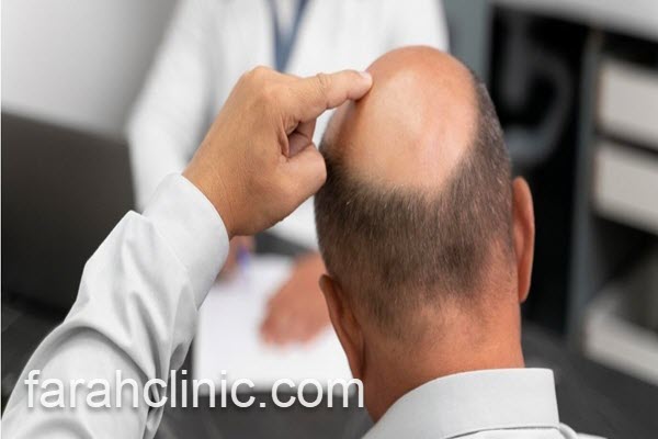 کاشت مو با به روزترین روش | فرح کلینیک 