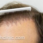 کاشت مو با جدیدترین روش | فرح کلینیک